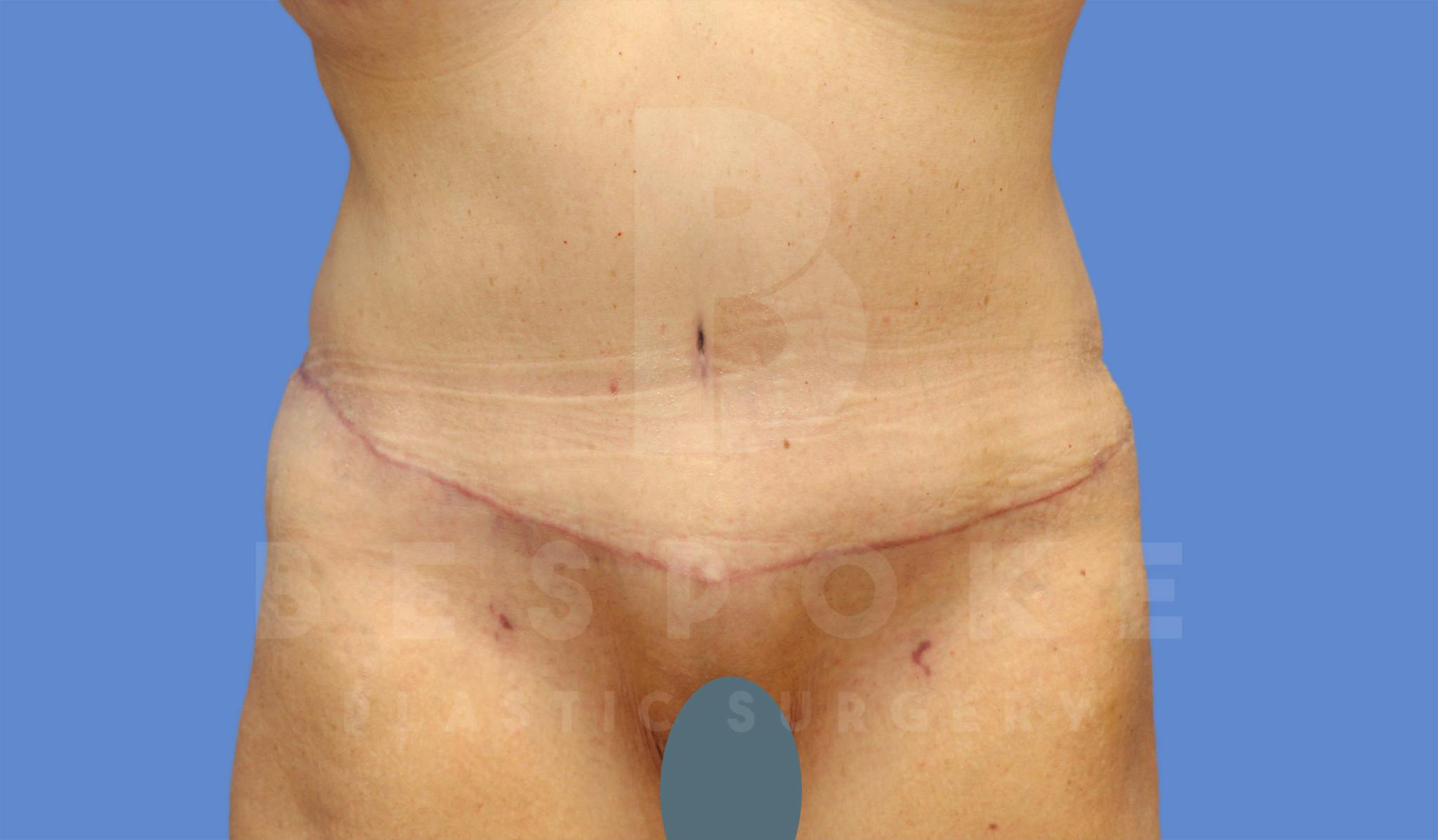 Tummy Tuck Before & After Gallery - Patient 4600015 - Image 2
