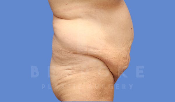 Extended Tummy Tuck Before & After Gallery - Patient 182449 - Image 5