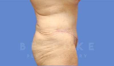 Extended Tummy Tuck Before & After Gallery - Patient 182449 - Image 6