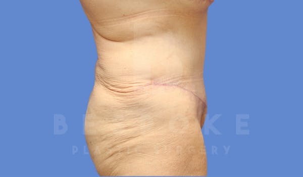 Extended Tummy Tuck Before & After Gallery - Patient 182449 - Image 6