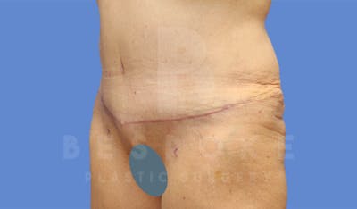 Tummy Tuck Before & After Gallery - Patient 4600015 - Image 8