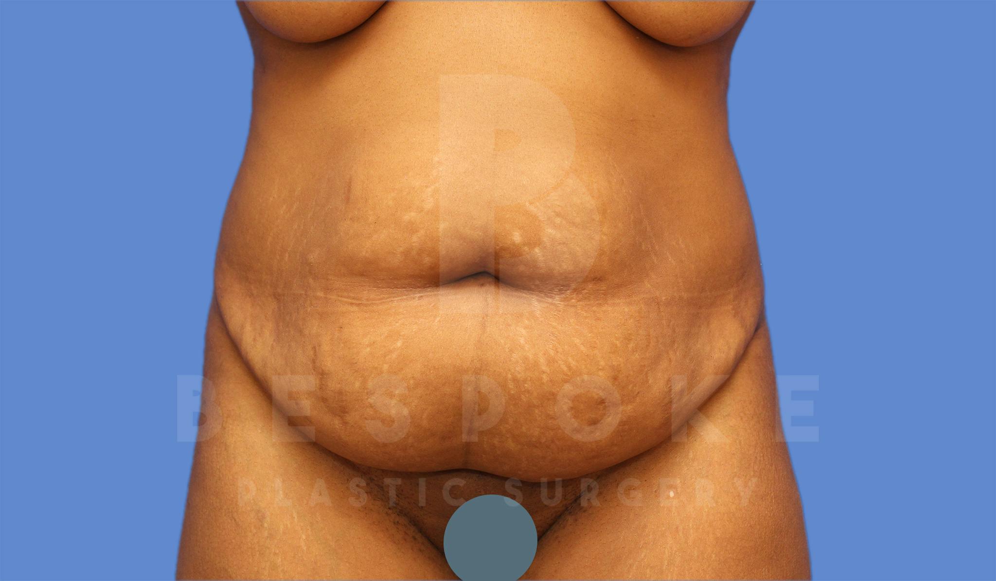 Tummy Tuck Before & After Gallery - Patient 4600016 - Image 1