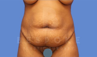 Tummy Tuck Before & After Gallery - Patient 4600016 - Image 1