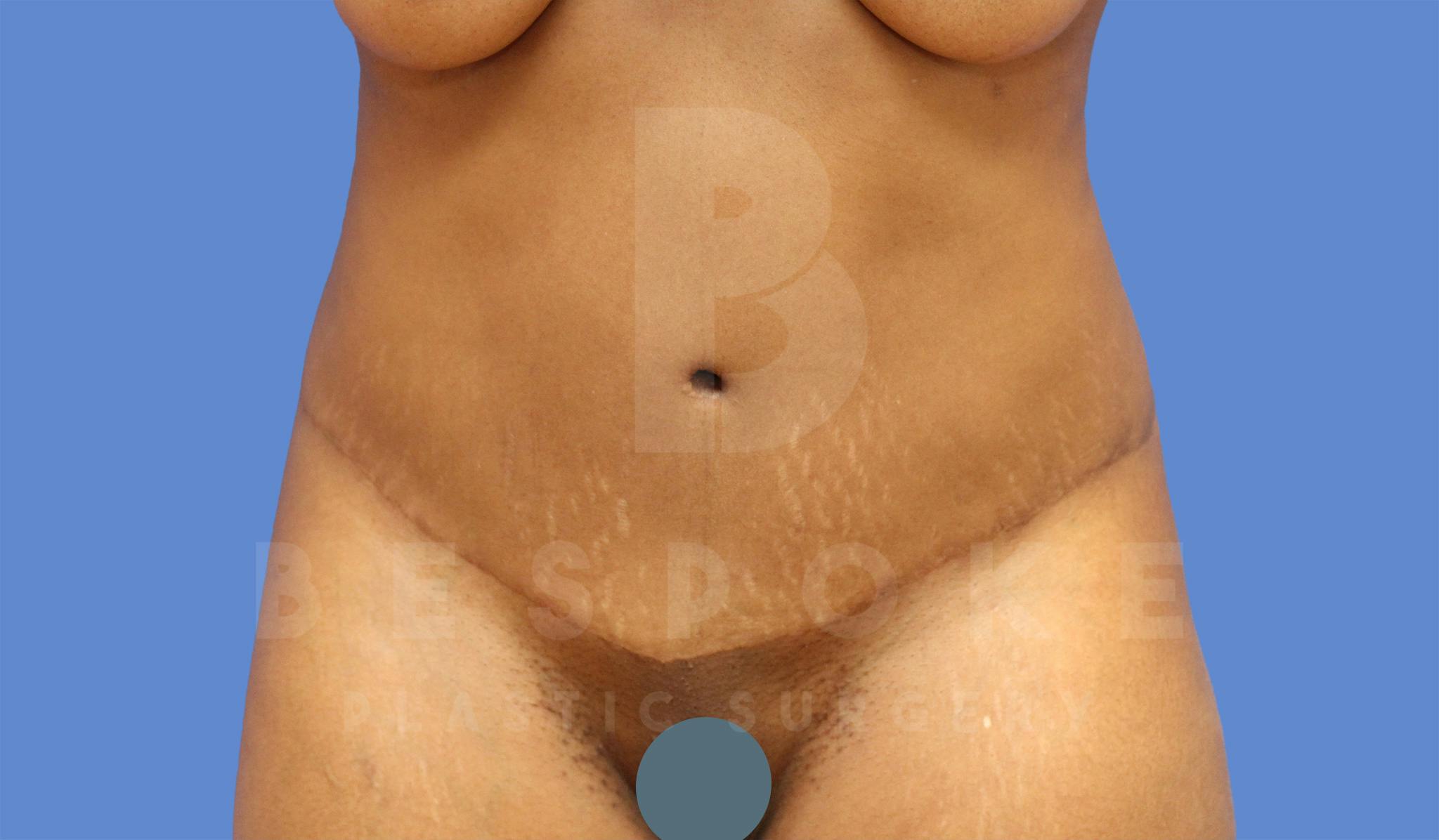 Tummy Tuck Before & After Gallery - Patient 4600016 - Image 2