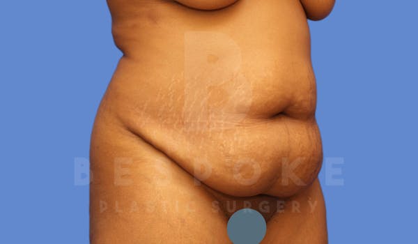 Tummy Tuck Before & After Gallery - Patient 4600016 - Image 3