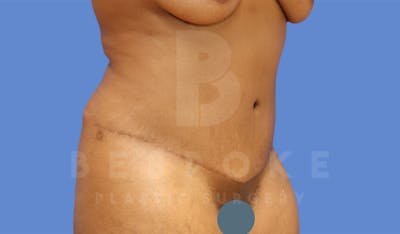 Tummy Tuck Before & After Gallery - Patient 4600016 - Image 4