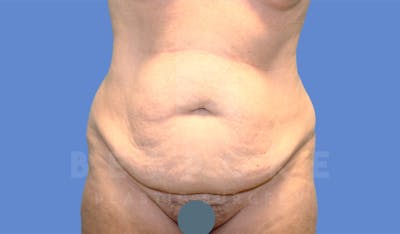 Tummy Tuck Before & After Gallery - Patient 4600017 - Image 1