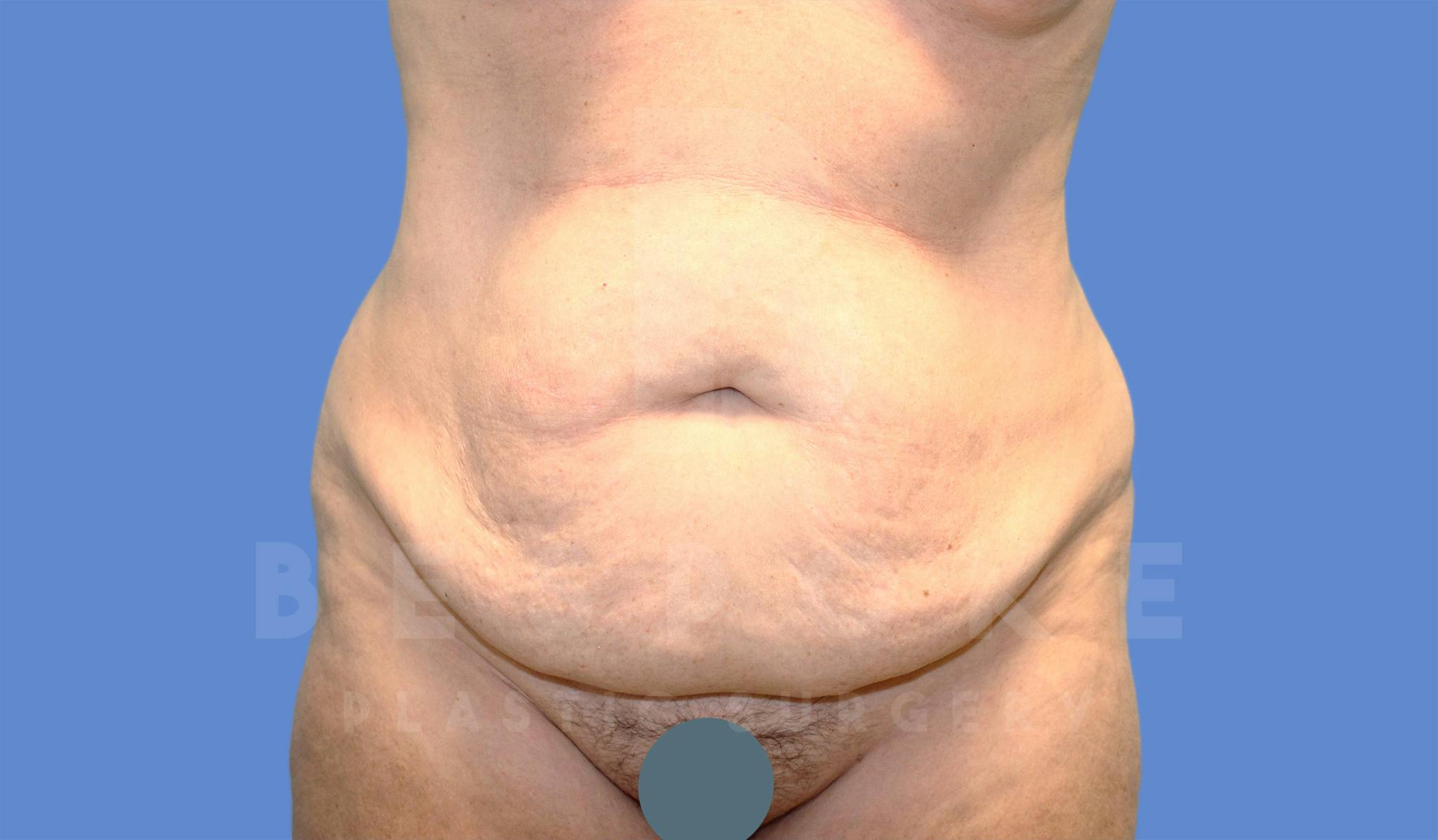 Tummy Tuck Gallery - Patient 4600017 - Image 1