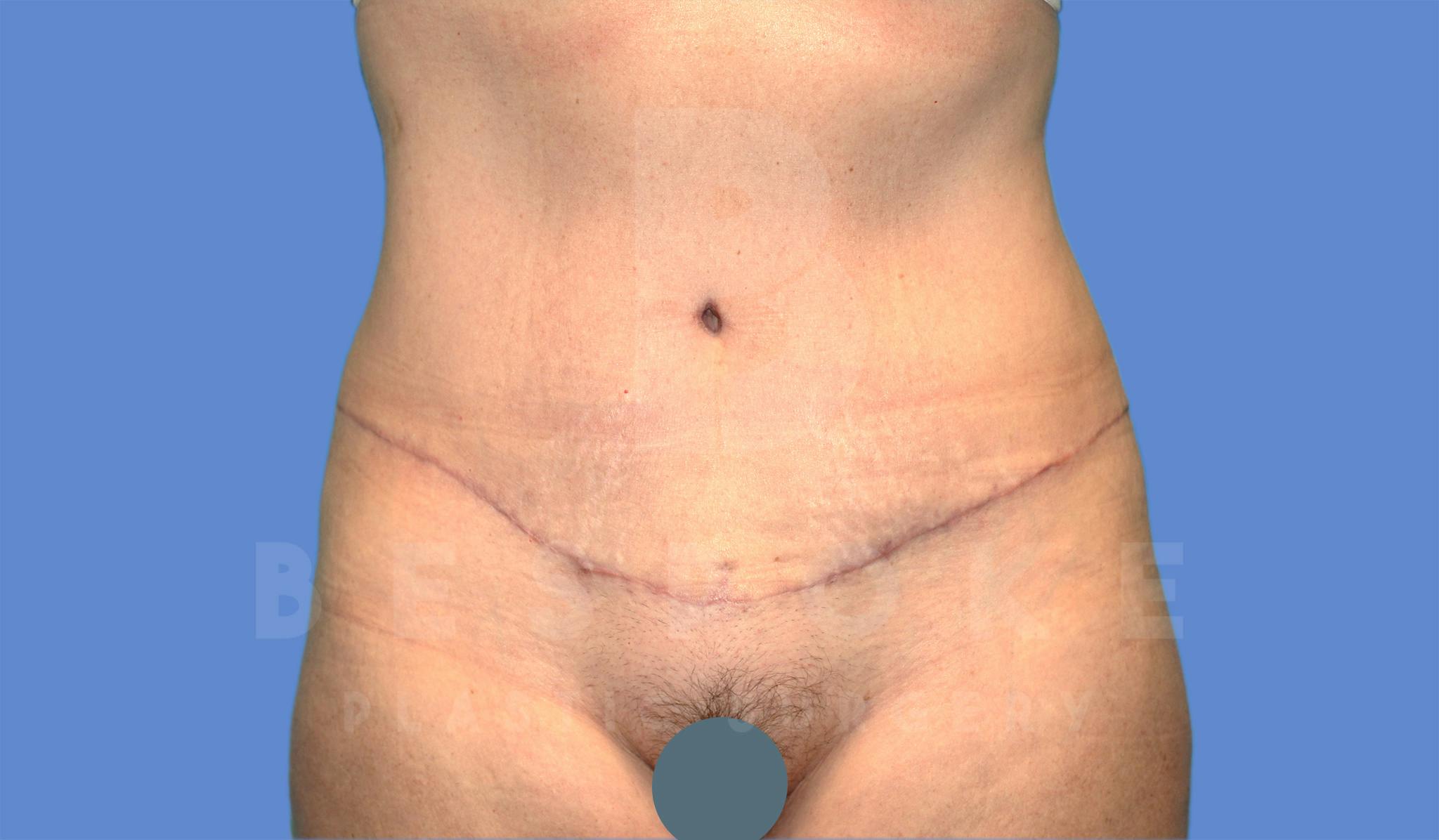 Tummy Tuck Before & After Gallery - Patient 4600017 - Image 2