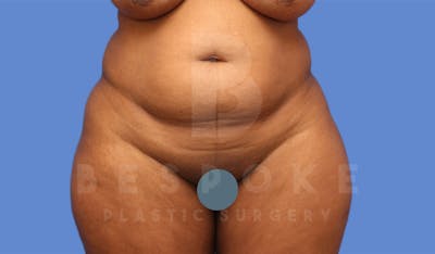 Tummy Tuck Gallery - Patient 4600018 - Image 1