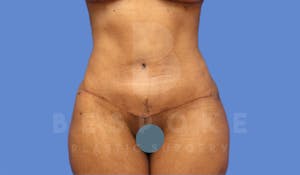 Before & After a Tummy Tuck Charlotte NC