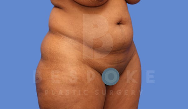 Tummy Tuck Gallery - Patient 4600018 - Image 3
