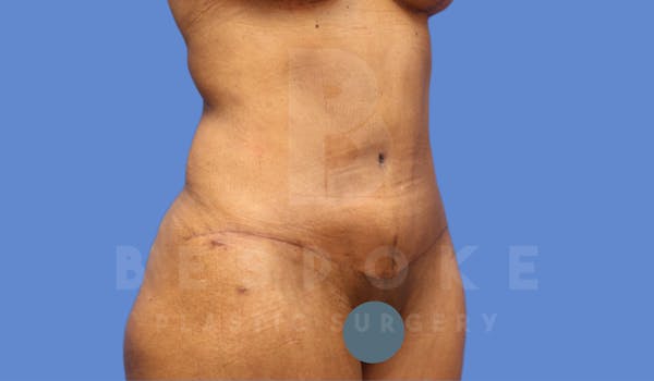 Tummy Tuck Before & After Gallery - Patient 4600018 - Image 4