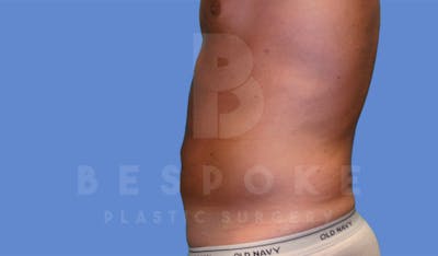 Liposuction Before & After Gallery - Patient 4622785 - Image 4