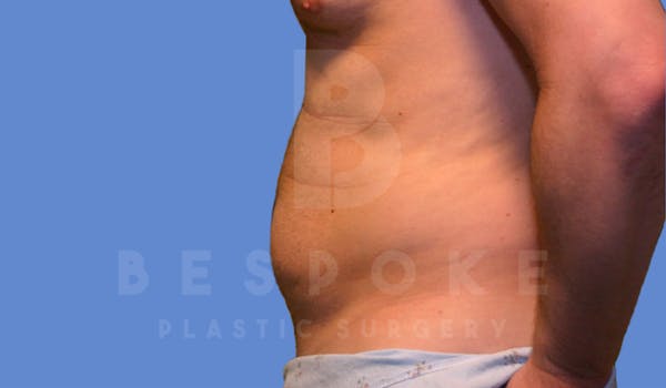 Liposuction Before & After Gallery - Patient 4622785 - Image 3