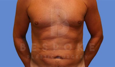 Liposuction Before & After Gallery - Patient 4622785 - Image 2