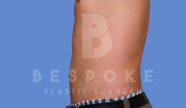 Liposuction Before & After Gallery - Patient 4622794 - Image 4