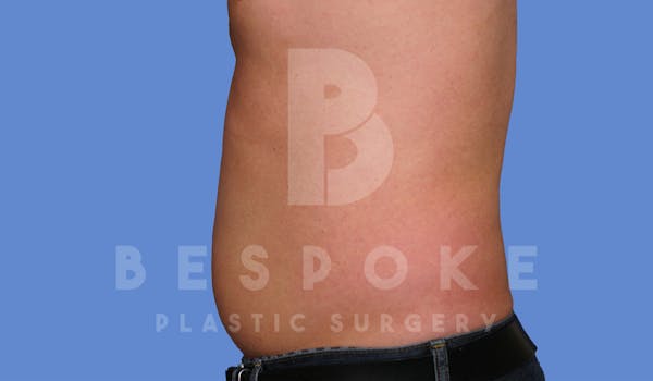 Liposuction Gallery - Patient 4622794 - Image 3