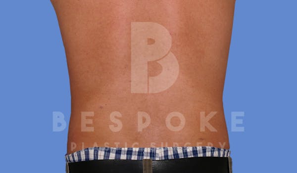 Liposuction Before & After Gallery - Patient 4622794 - Image 6