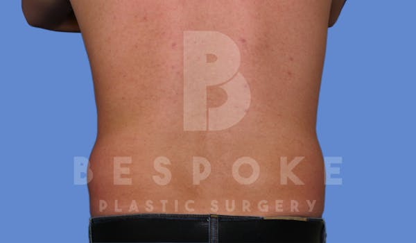 Liposuction Before & After Gallery - Patient 4622794 - Image 5