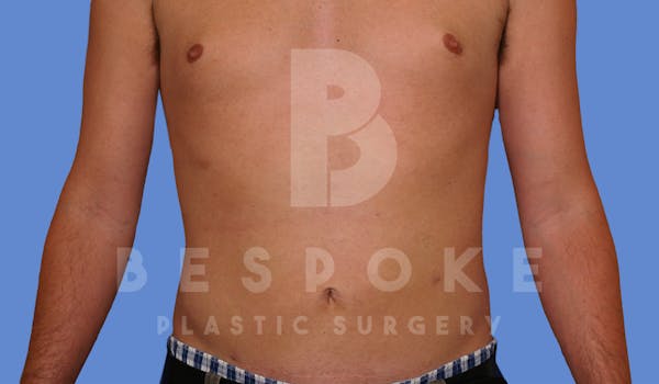 Liposuction Before & After Gallery - Patient 4622794 - Image 2