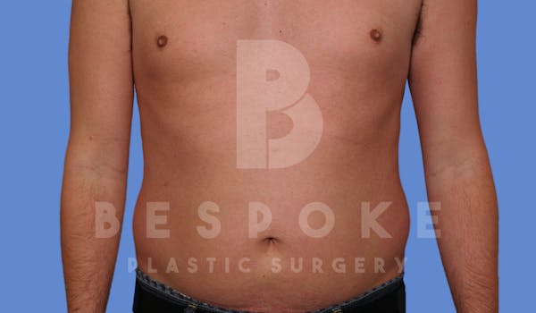 Liposuction Before & After Gallery - Patient 4622794 - Image 1