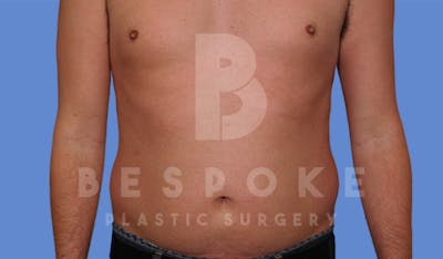 Liposuction Gallery - Patient 4622794 - Image 1
