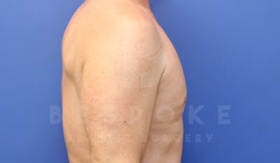 Gynecomastia Before & After Gallery - Patient 4622807 - Image 6
