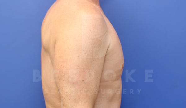 Gynecomastia Before & After Gallery - Patient 4622807 - Image 6