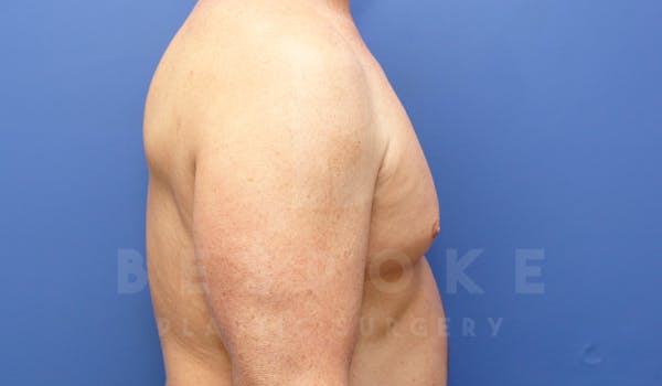 Gynecomastia Before & After Gallery - Patient 4622807 - Image 5