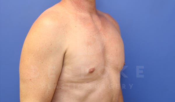 Gynecomastia Before & After Gallery - Patient 4622807 - Image 4
