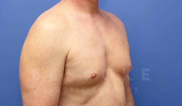 Gynecomastia Before & After Gallery - Patient 4622807 - Image 3