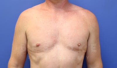 Gynecomastia Before & After Gallery - Patient 4622807 - Image 2