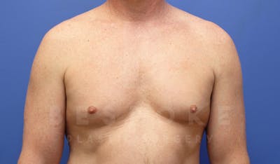 Gynecomastia Before & After Gallery - Patient 4622807 - Image 1