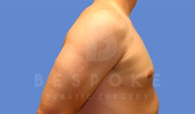 Gynecomastia Before & After Gallery - Patient 4622813 - Image 6
