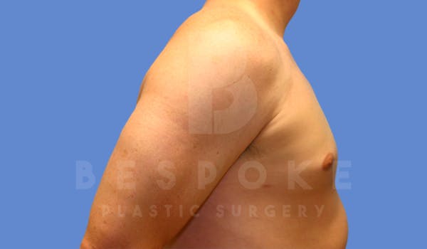 Gynecomastia Before & After Gallery - Patient 4622813 - Image 6