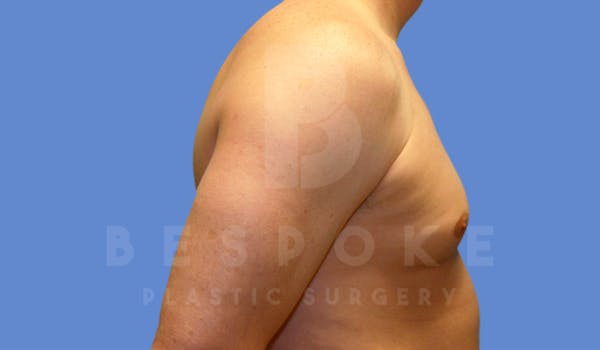 Gynecomastia Before & After Gallery - Patient 4622813 - Image 5