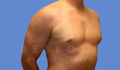 Gynecomastia Before & After Gallery - Patient 4622813 - Image 4