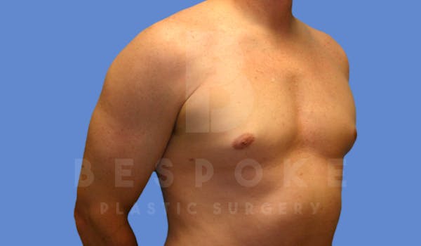 Gynecomastia Before & After Gallery - Patient 4622813 - Image 4