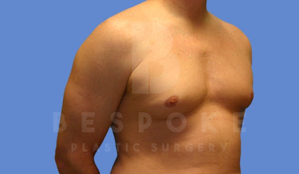 Gynecomastia Before & After Gallery - Patient 4622813 - Image 3