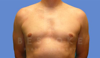 Gynecomastia Before & After Gallery - Patient 4622813 - Image 2