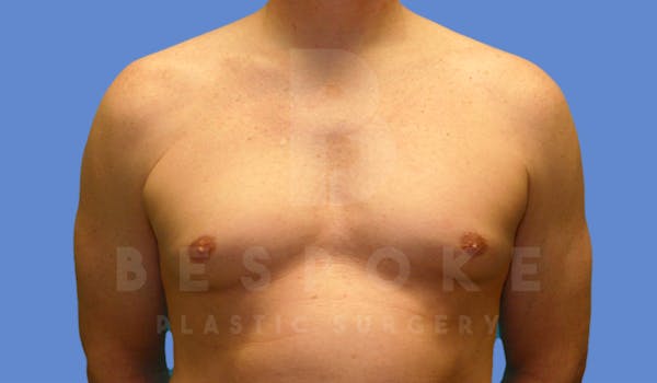 Gynecomastia Before & After Gallery - Patient 4622813 - Image 1