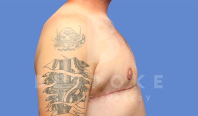 Gynecomastia Before & After Gallery - Patient 4622819 - Image 6