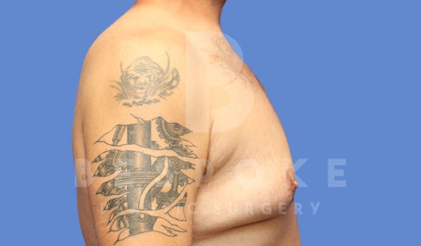 Gynecomastia Before & After Gallery - Patient 4622819 - Image 5