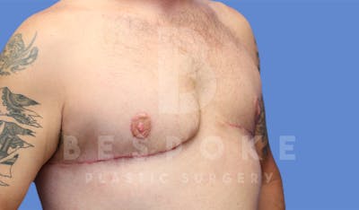 Gynecomastia Before & After Gallery - Patient 4622819 - Image 4