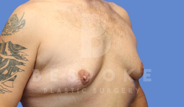Gynecomastia Before & After Gallery - Patient 4622819 - Image 3