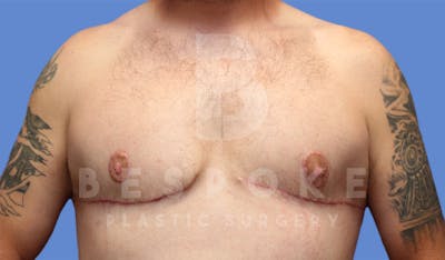 Gynecomastia Before & After Gallery - Patient 4622819 - Image 2