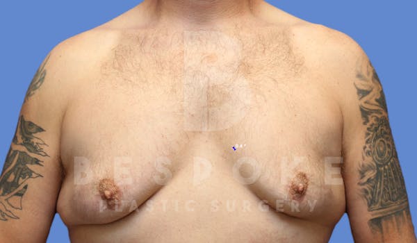 Gynecomastia Before & After Gallery - Patient 4622819 - Image 1