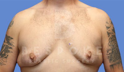 Gynecomastia Before & After Gallery - Patient 4622819 - Image 1