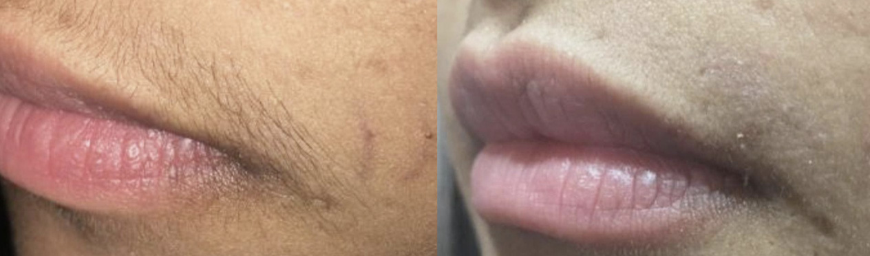 before and after of laser hair removal on upper lip in Charlotte, NC
